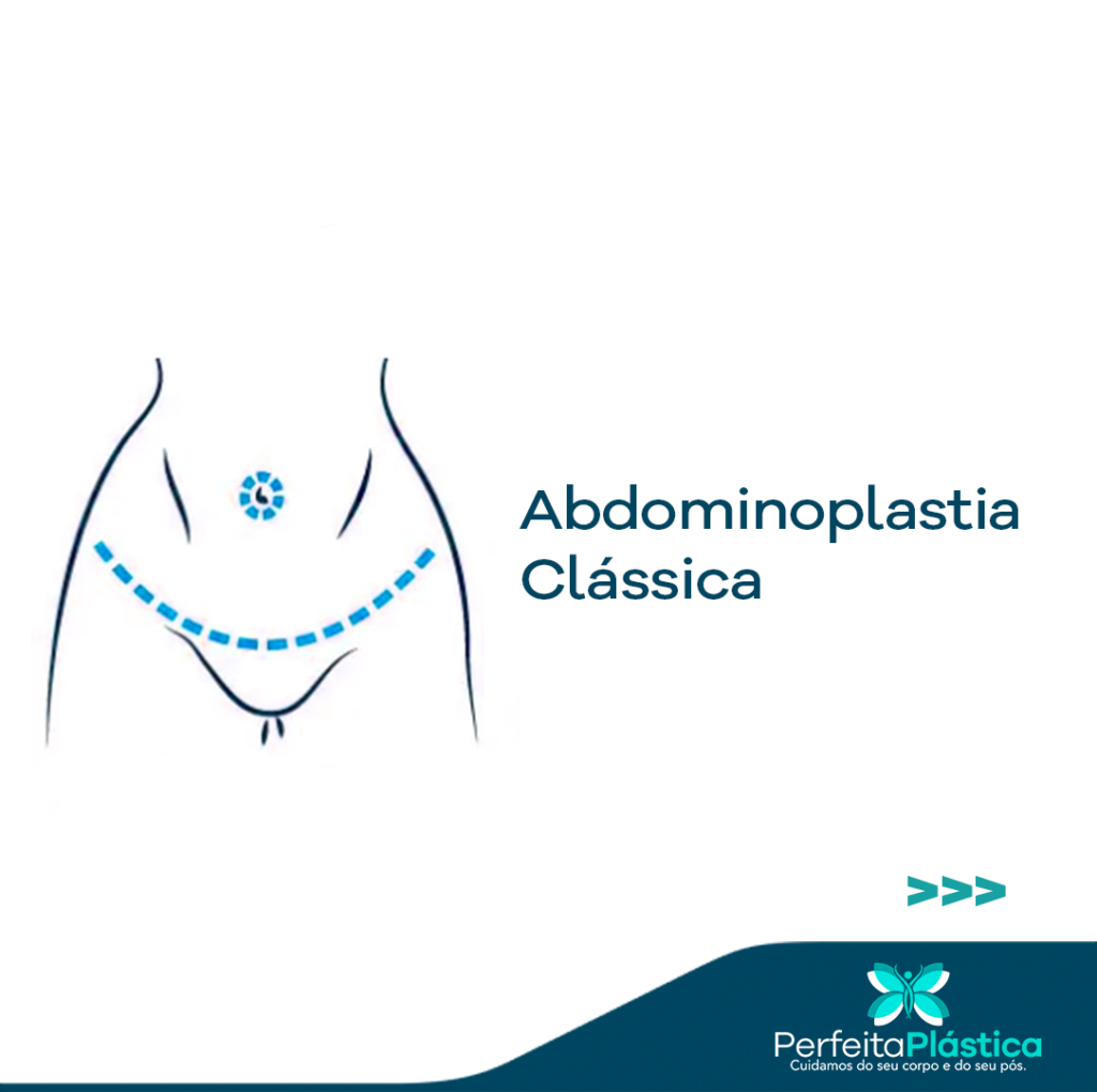 Quais S O Os Tipos De Abdominoplastia