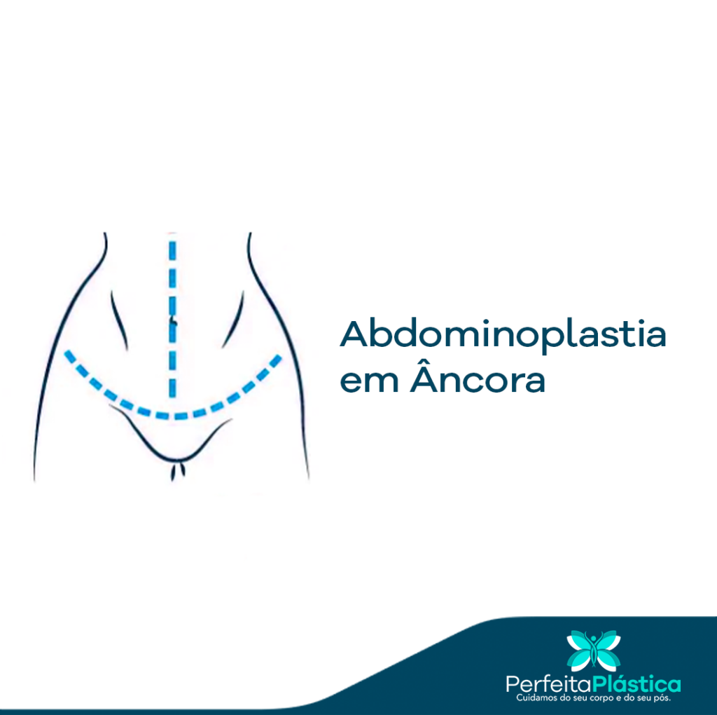 Quais S O Os Tipos De Abdominoplastia