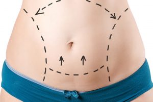 marcações pra realizar abdominoplastia